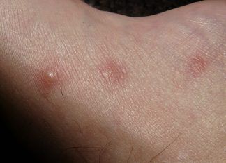 Ciencia ya comienza a estudiar la comezón Estiman que la ciencia puede responder más preguntas que las esperadas dentro de unos años.