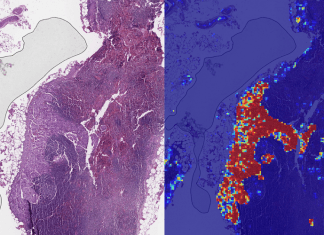 La IA de Google es más precisa diagnosticando el cáncer de mama que los propios expertos La IA de google