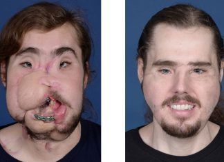 Un trasplante de rostro que resultó ser un éxito total Un trasplante de rostro