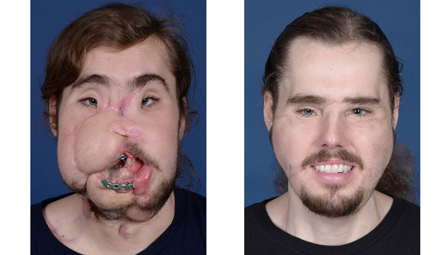 Un trasplante de rostro